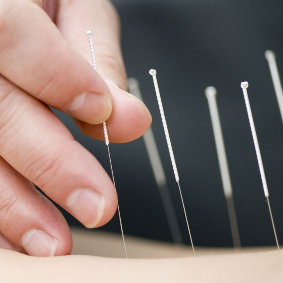 Acupuncture treatment Acupuncture needles being placed